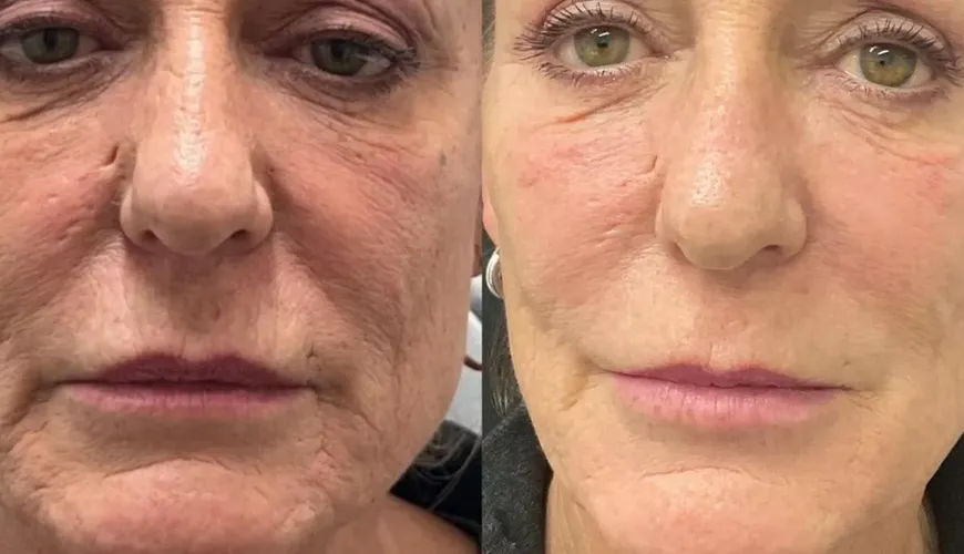 Celebs Sound the Alarm on 'Ozempic Face' – The Dark Side of Rapid Weight Loss