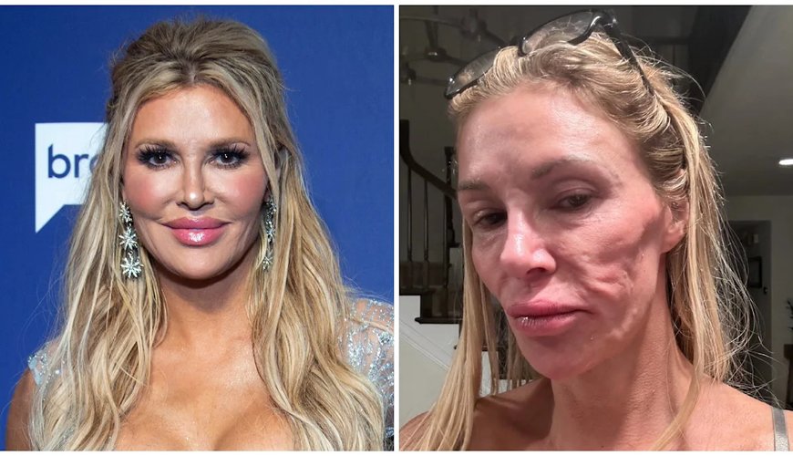 Brandi Glanville's Tumor Diagnosis: The Mystery Behind Her Facial Disfigurement