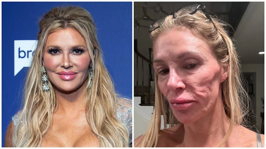 Brandi Glanville's Tumor Diagnosis: The Mystery Behind Her Facial Disfigurement
