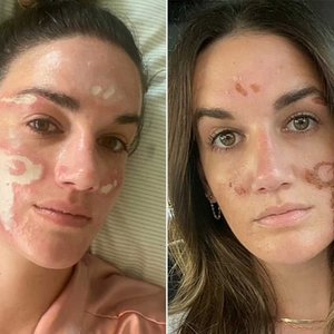 Celebrity Facialist's Chemical Peel Nightmare: Woman Claims $90K in Damages