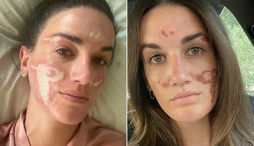 Celebrity Facialist's Chemical Peel Nightmare: Woman Claims $90K in Damages