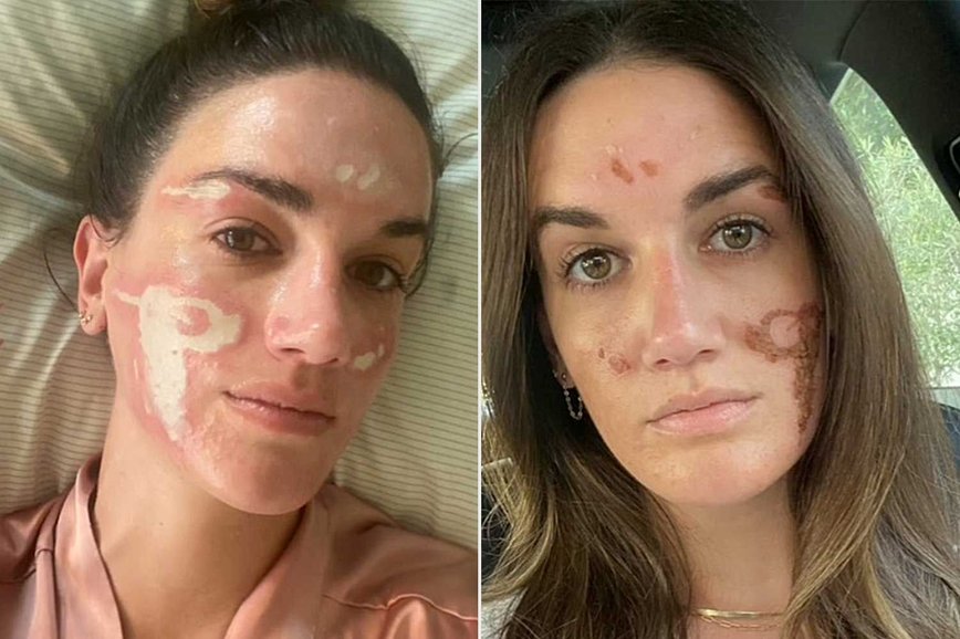 Celebrity Facialist's Chemical Peel Nightmare: Woman Claims $90K in Damages